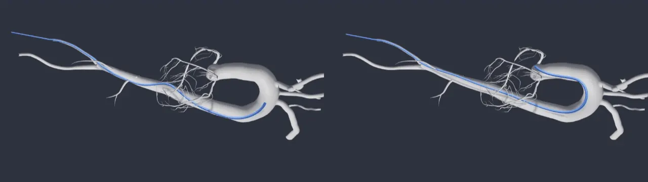 Figura 1. Inserción y dirección de un catéter a través de un modelo vascular