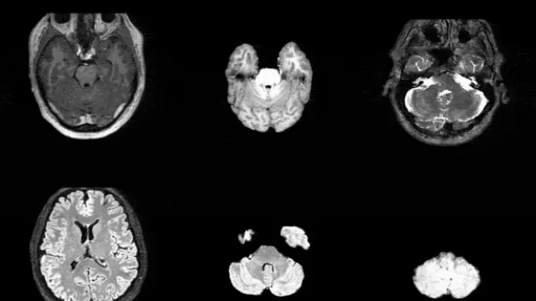 NVIDIA abre síntesis 3D de CT y MRI con MAISI-v2